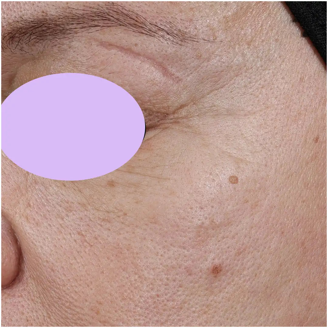 Peau avant utilisation du duo Harmo anti-âge, photo de l'étude clinique Complife, volontaire 34